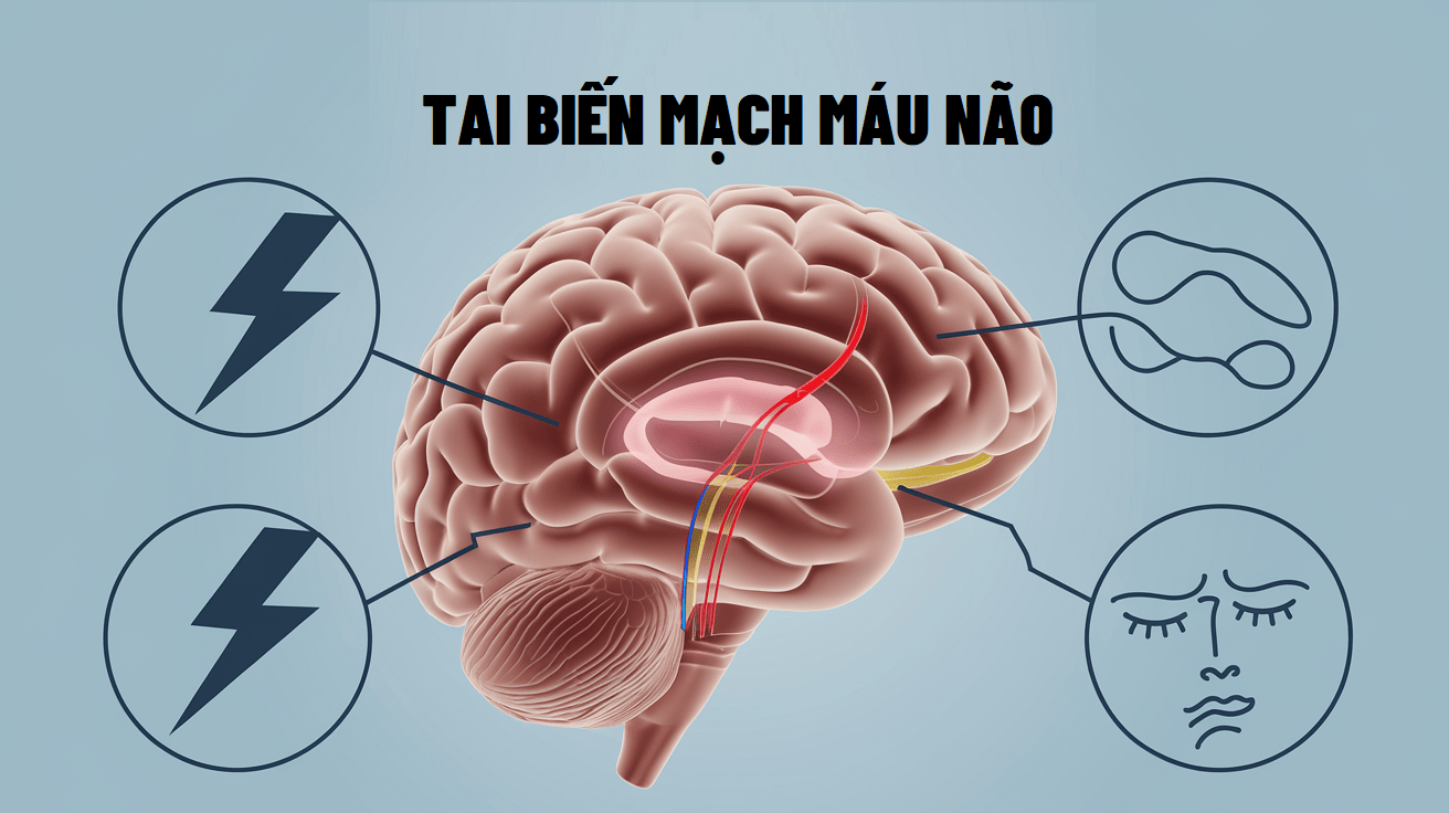 Tìm hiểu về tai biến mạch máu não