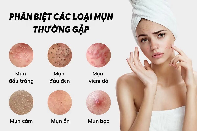 các loại mụn phổ biến