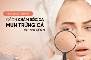 Chăm sóc da mụn hiệu quả