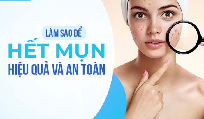 làm thế nào để trị mụn hiệu quả tại nhà