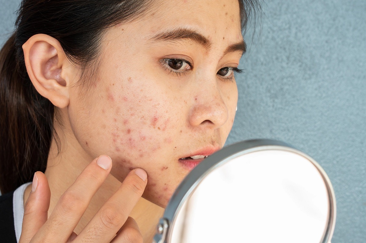 sai lầm khi sử dụng kem đánh răng để trị mụn